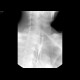 Carcinoma of oesophagus, middle third, bifurcation stent: RF - Fluoroscopy